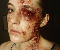 Infection
