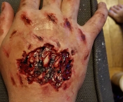 Hand Injury